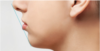 レディエッセのダウンタイム