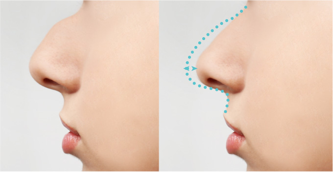 鼻背形成で鼻の高さが術前よりも低くなりませんか？