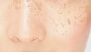 シミ・美白・ニキビのお悩み