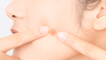 シミ・美白・ニキビのお悩み