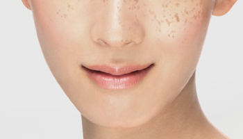 シミ・美白・ニキビのお悩み