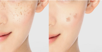 肝斑とシミってどう違うの？原因はなんですか？